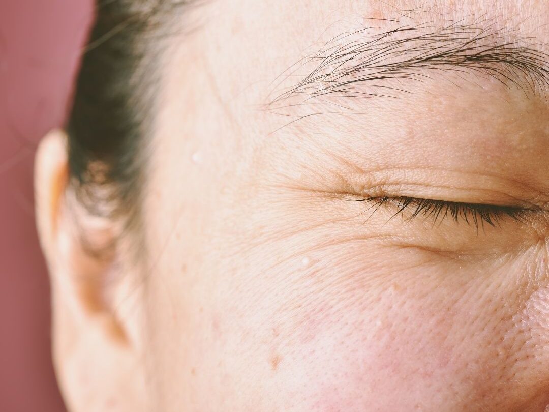 eye wrinkles