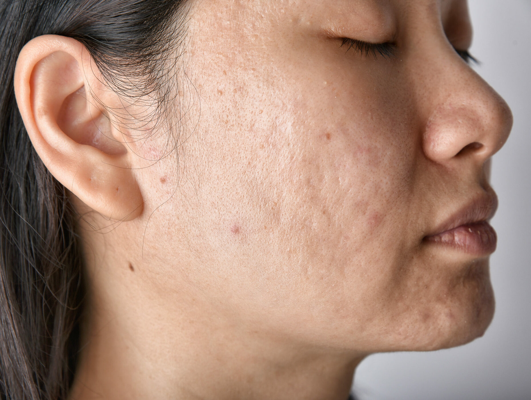 woman with acne scars