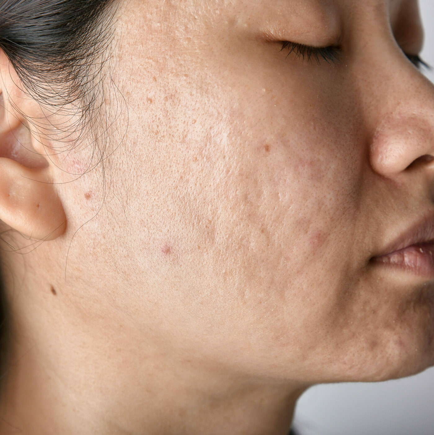 BAC Acne Scars Removal Treatments