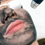 patient doing carbon laser peel in Singapore