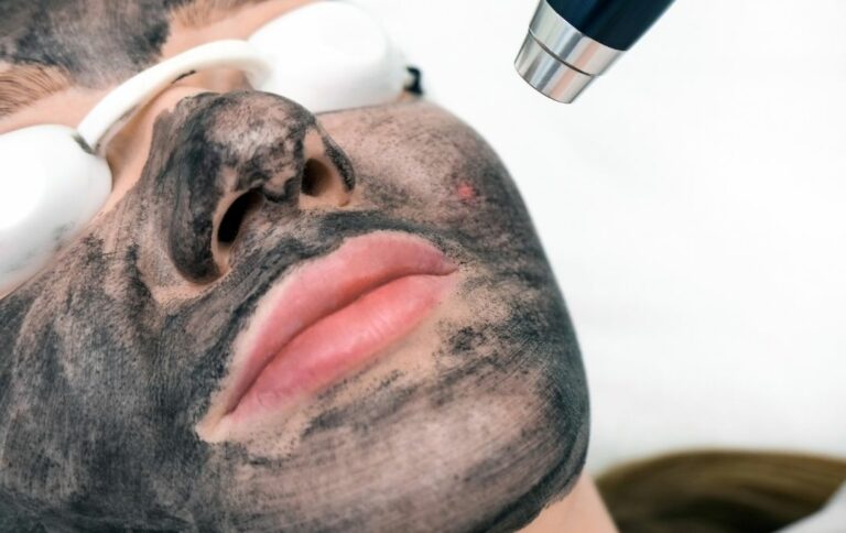 patient doing carbon laser peel in Singapore