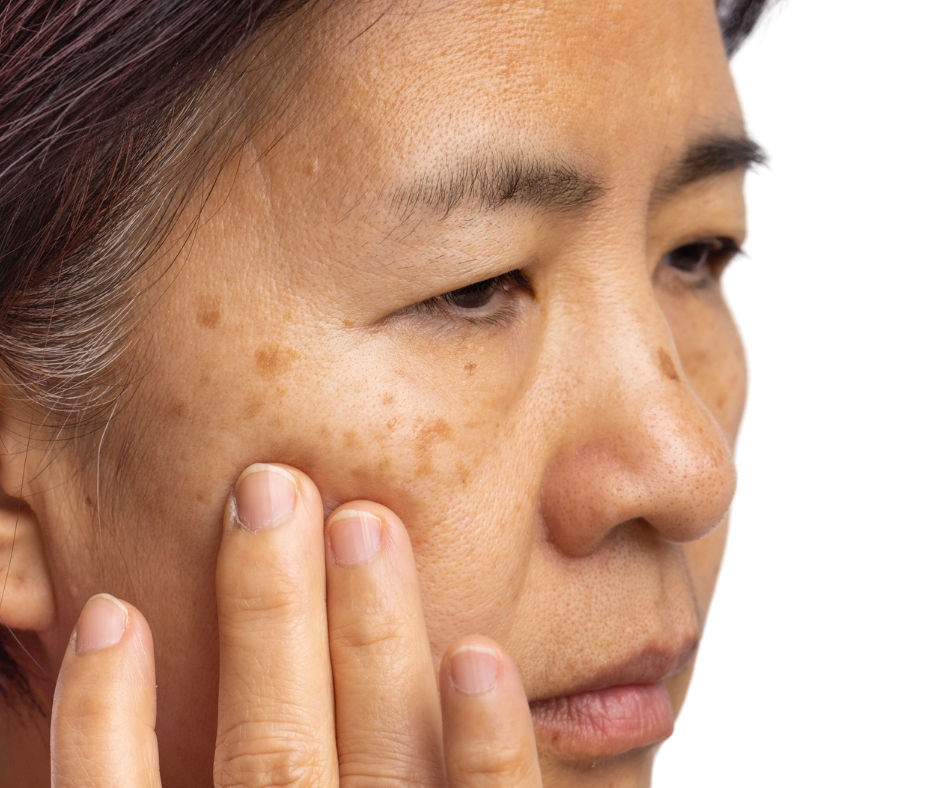 Old lady with pigmentation on face