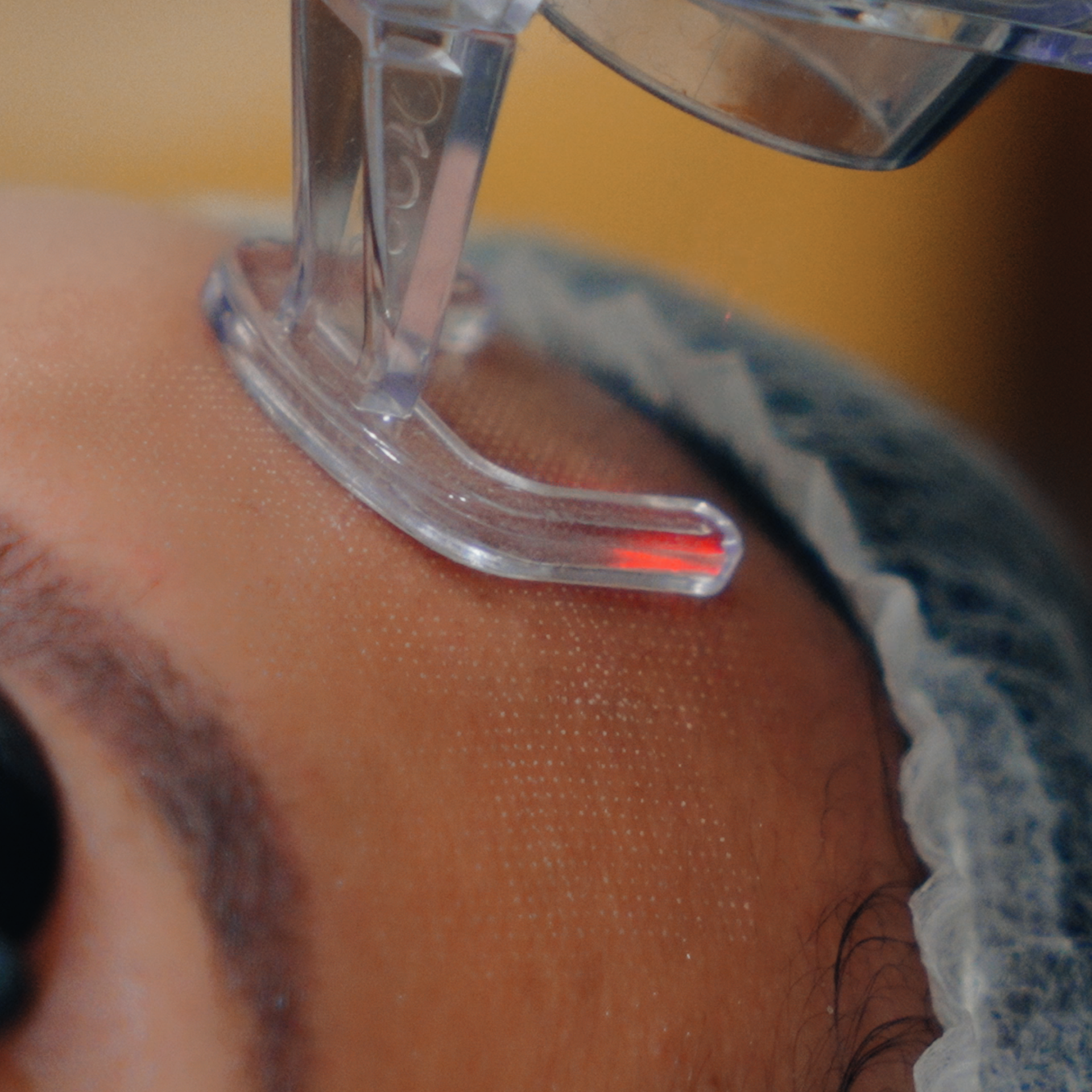 Fractional CO2 done by Doctor Philip