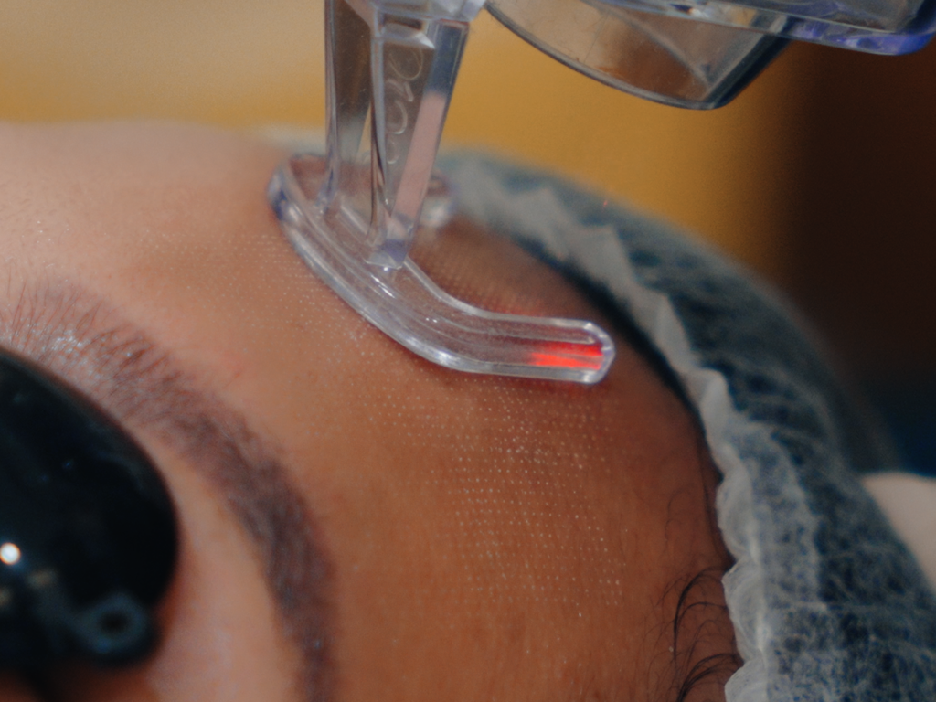 Fractional CO2 done by Doctor Philip