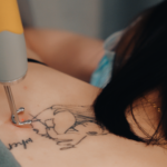 tattoo laser removal