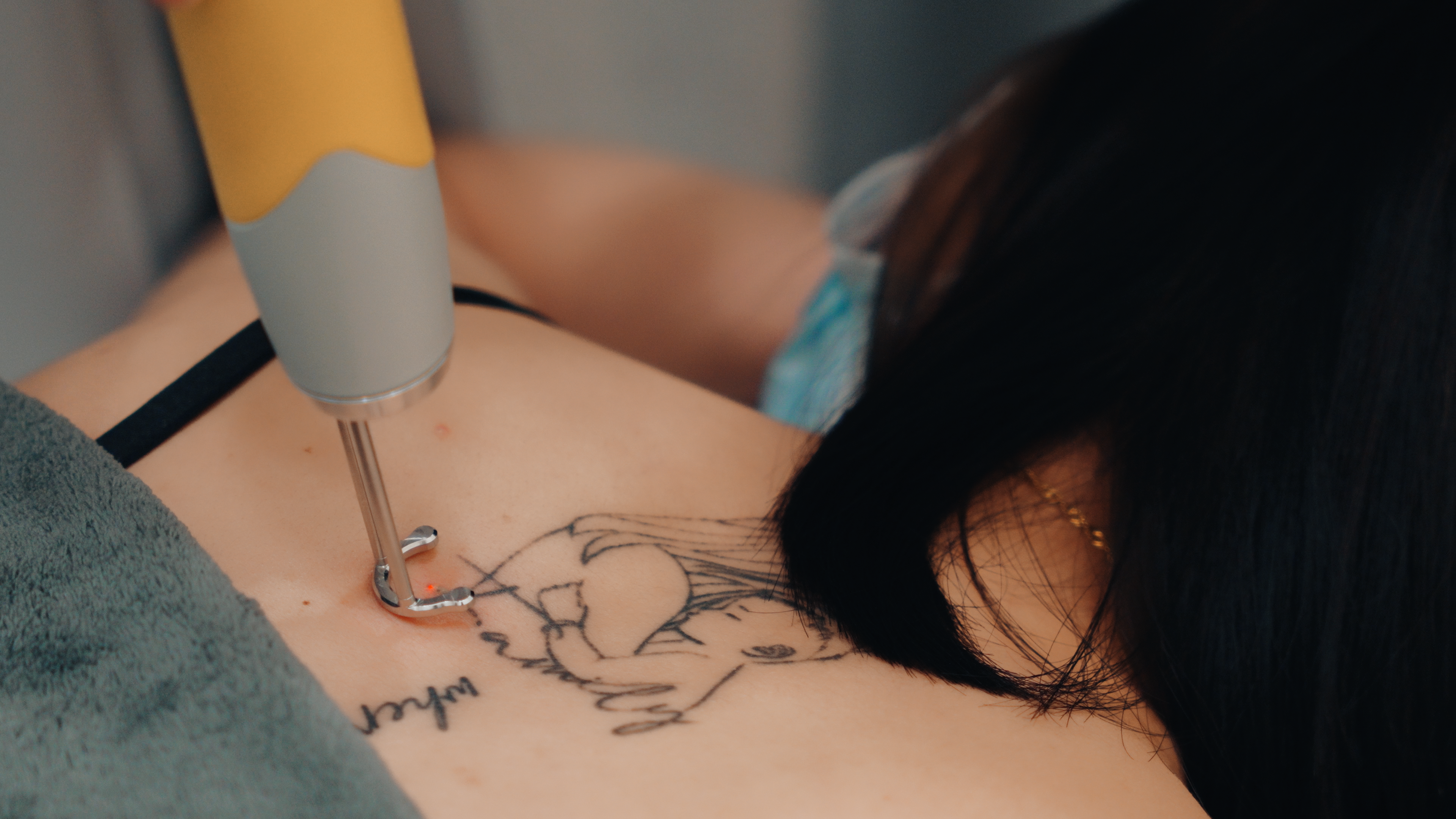 tattoo laser removal