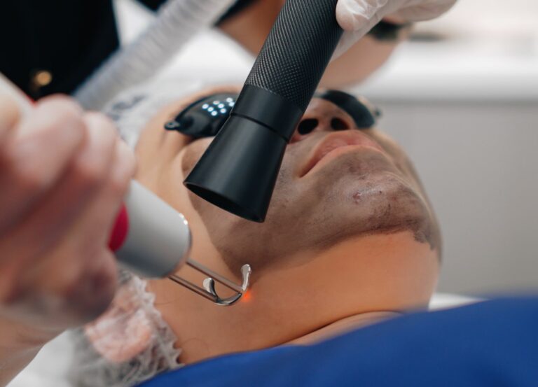 4 Ultimate Benefits To A Clear Skin With Carbon Laser Peel