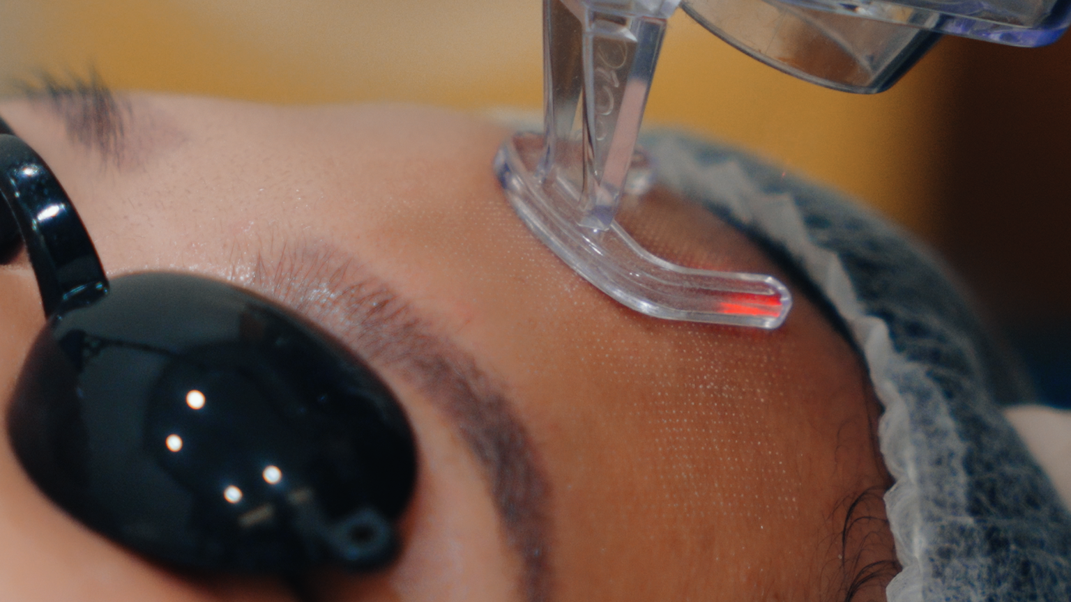 Explore The Magic Of Fractional CO2 Laser Stretch Marks