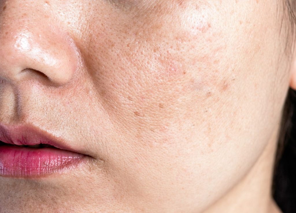 3 Ways Pico Laser Can Help With Stubborn Pigmentations