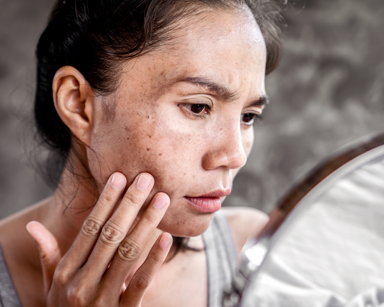 pico laser for melasma