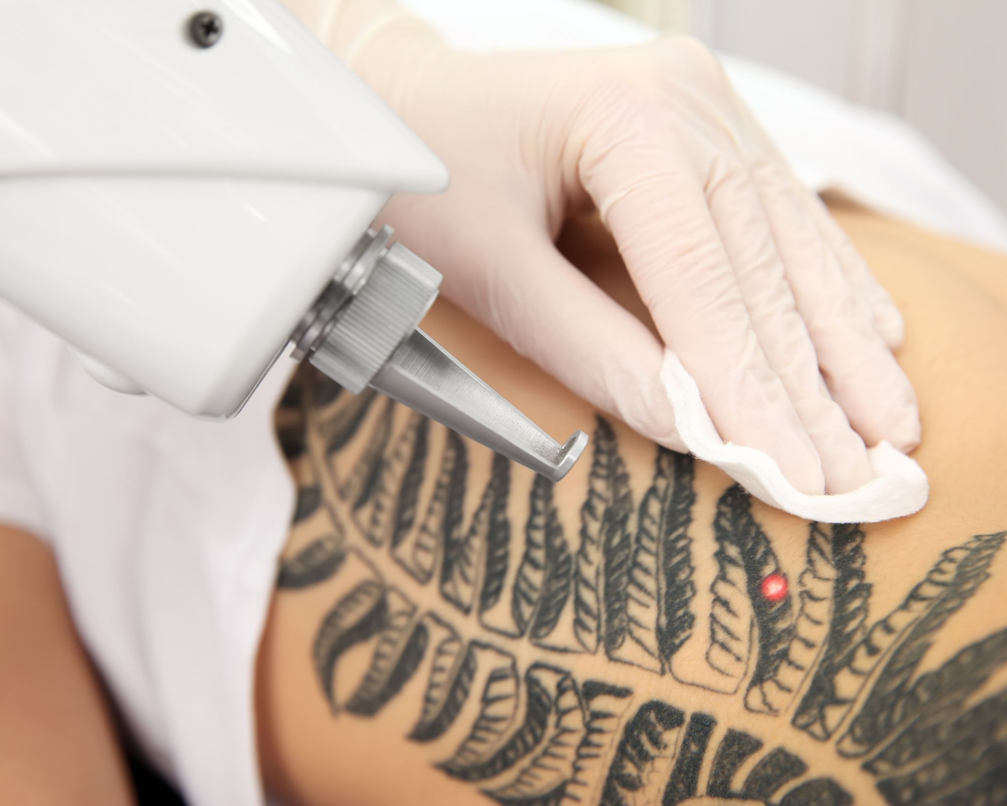 Pico-Laser-tattoo-removal-1