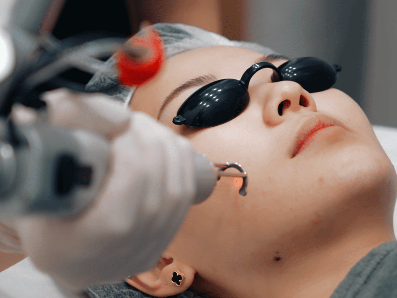 Pico Laser treatment for Rosacea