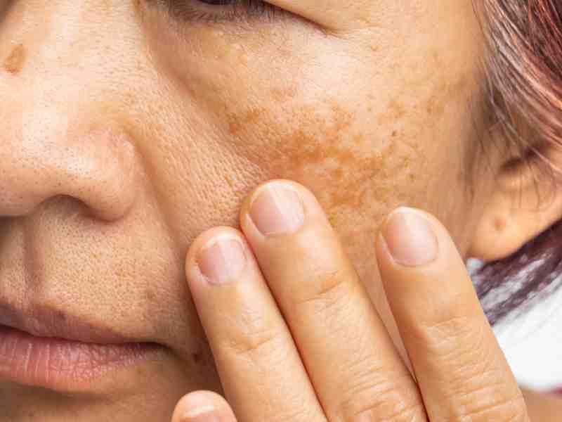 Melasma is Common Among Women