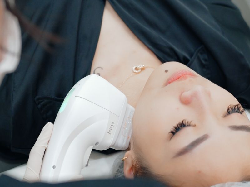 Before & After a HIFU Treatment