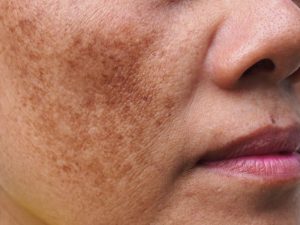Pico Laser for Pigmentation