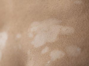 Uneven Skin Tone Pico Laser
