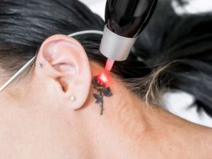 Pico Laser for Tattoo