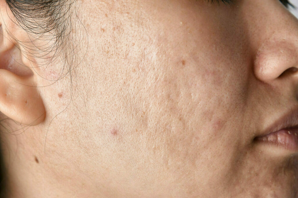 Pico Laser for Acne Scars