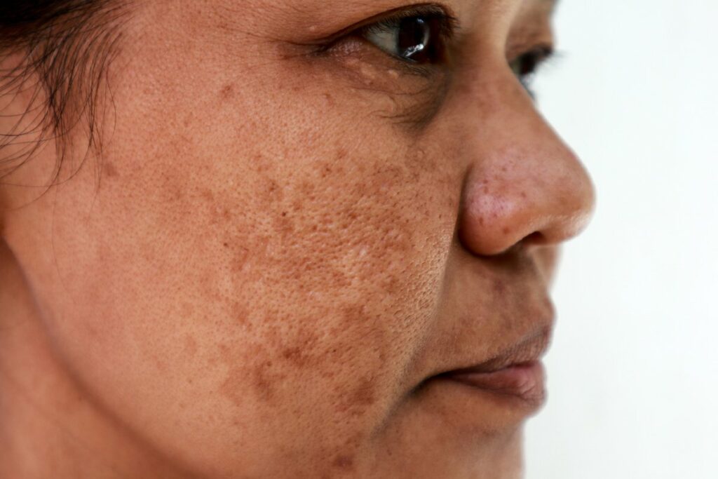 pico laser for melasma