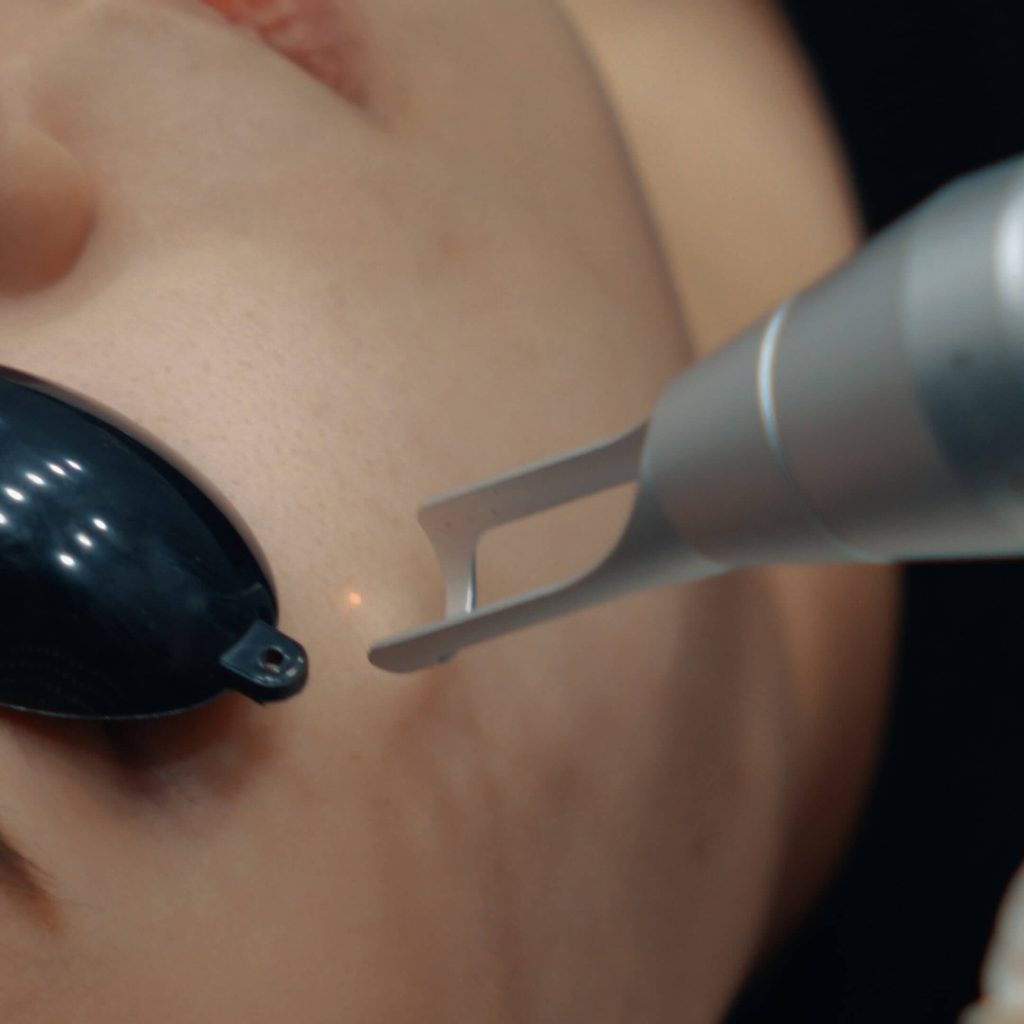 Complete Guide to Pico Laser in Singapore