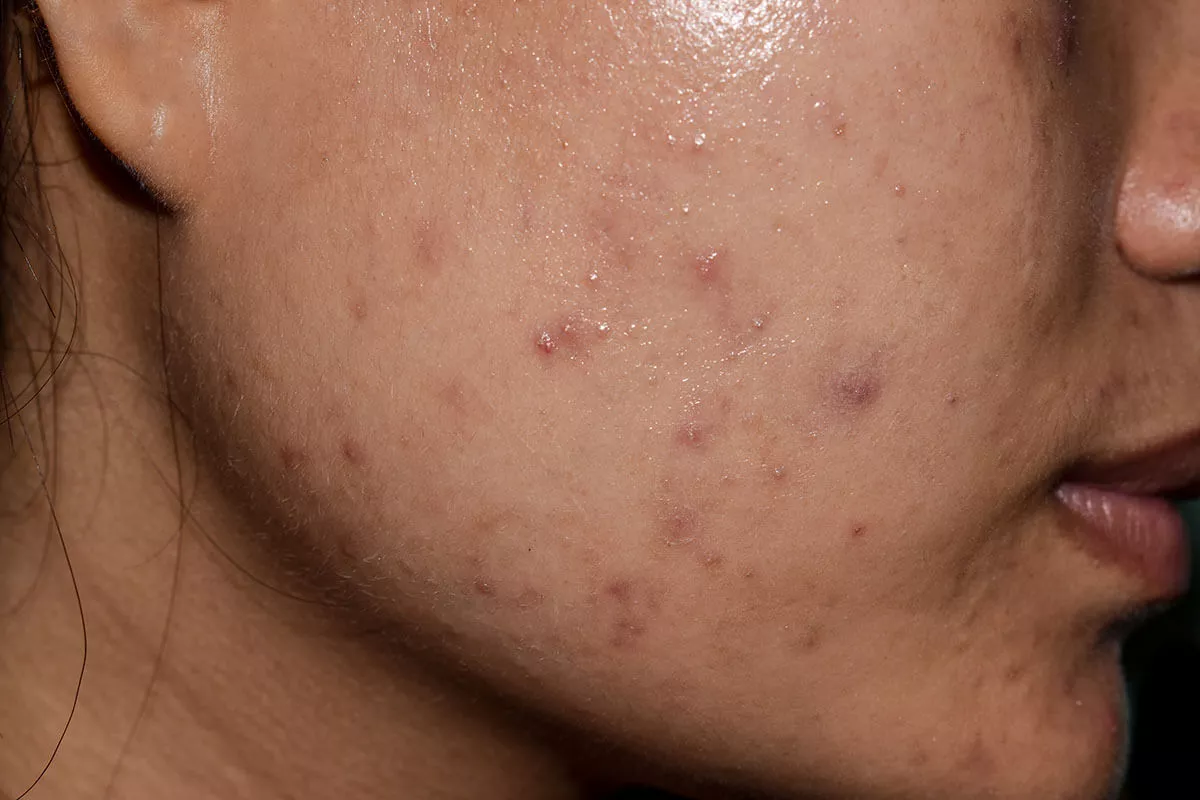 Keloid Scars
