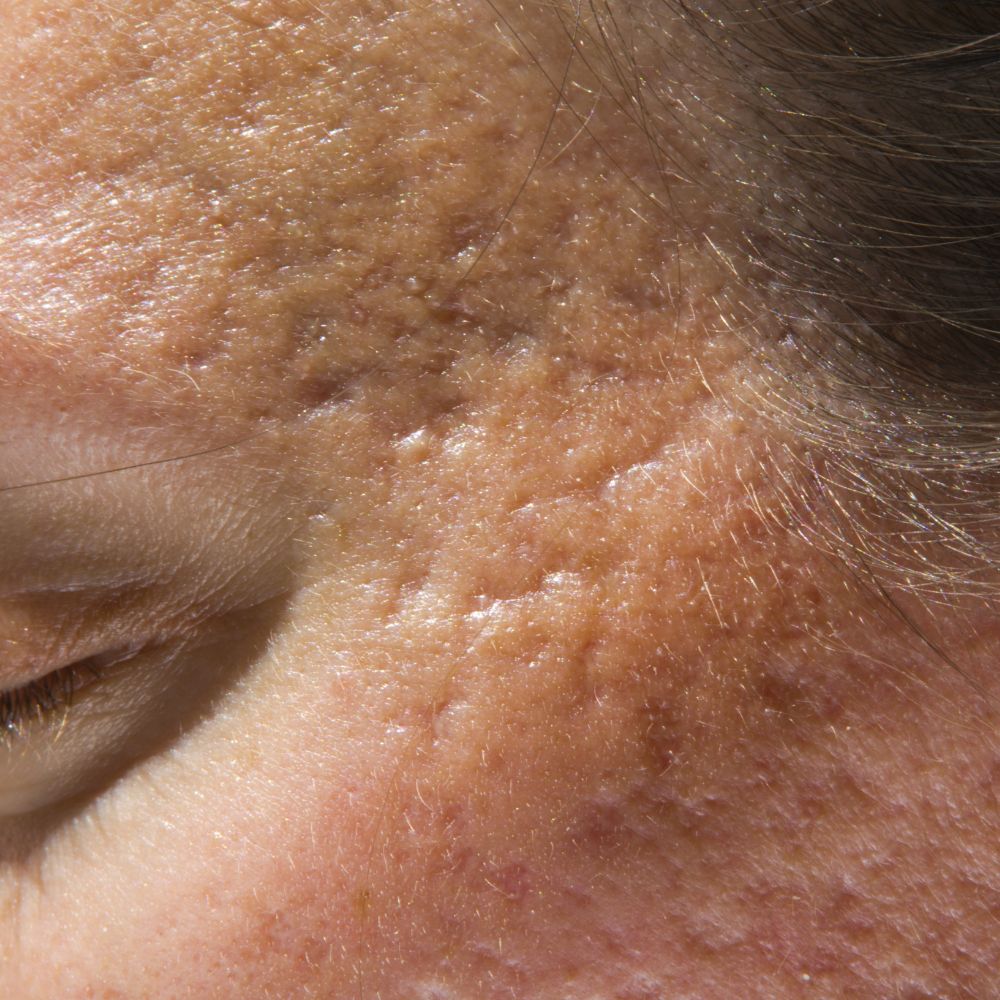 Old Age Acne Scar