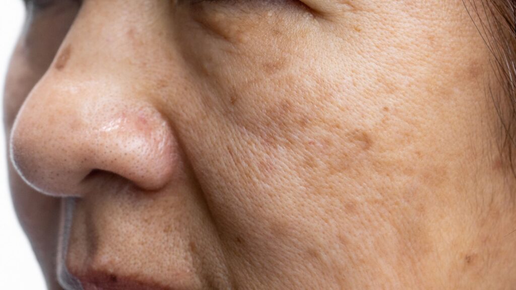 Sunspots Pigmentation