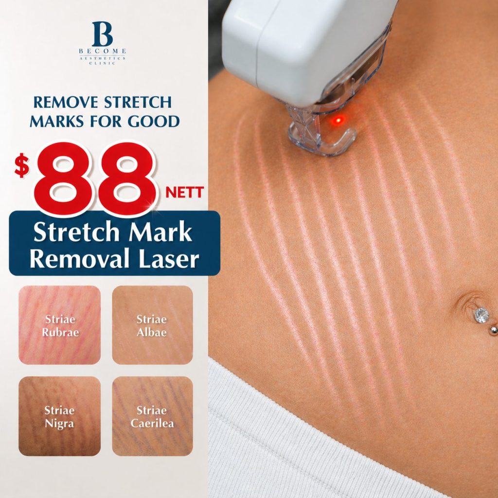 Stretch Mark Removal $88