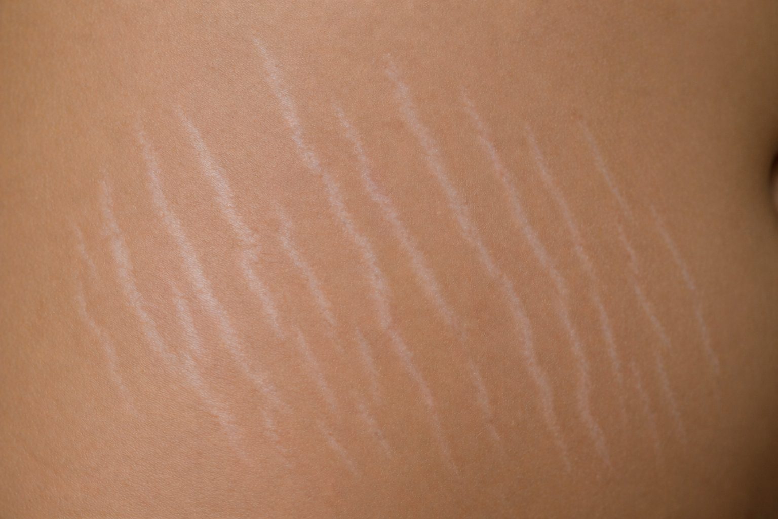 Striae Albae Stretch Marks