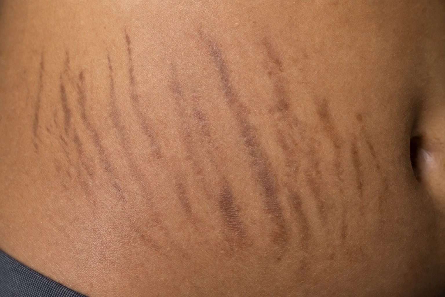 Striae Nigra Stretch Marks