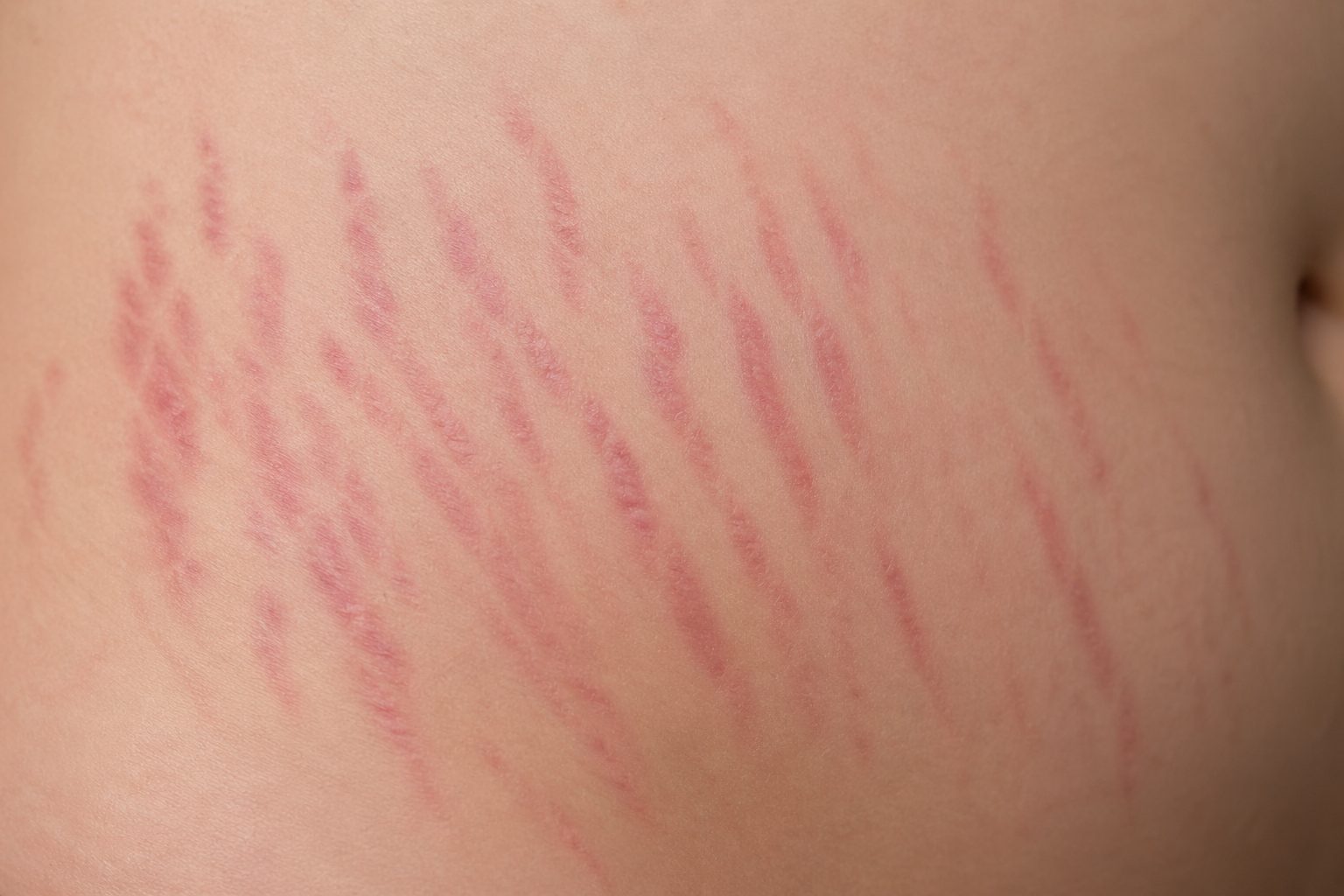 Striae Rubrae Stertch Marks
