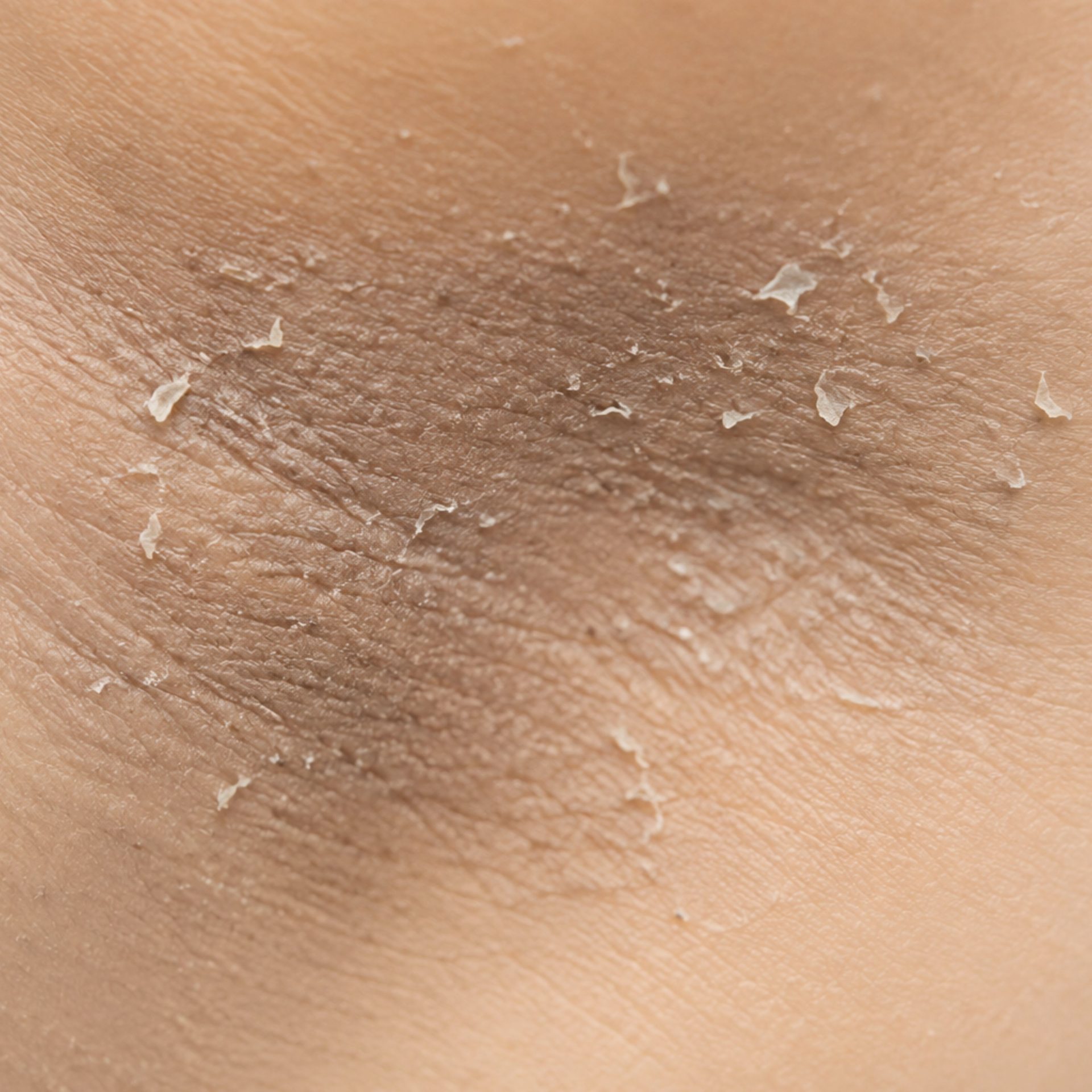 dead skin buildup