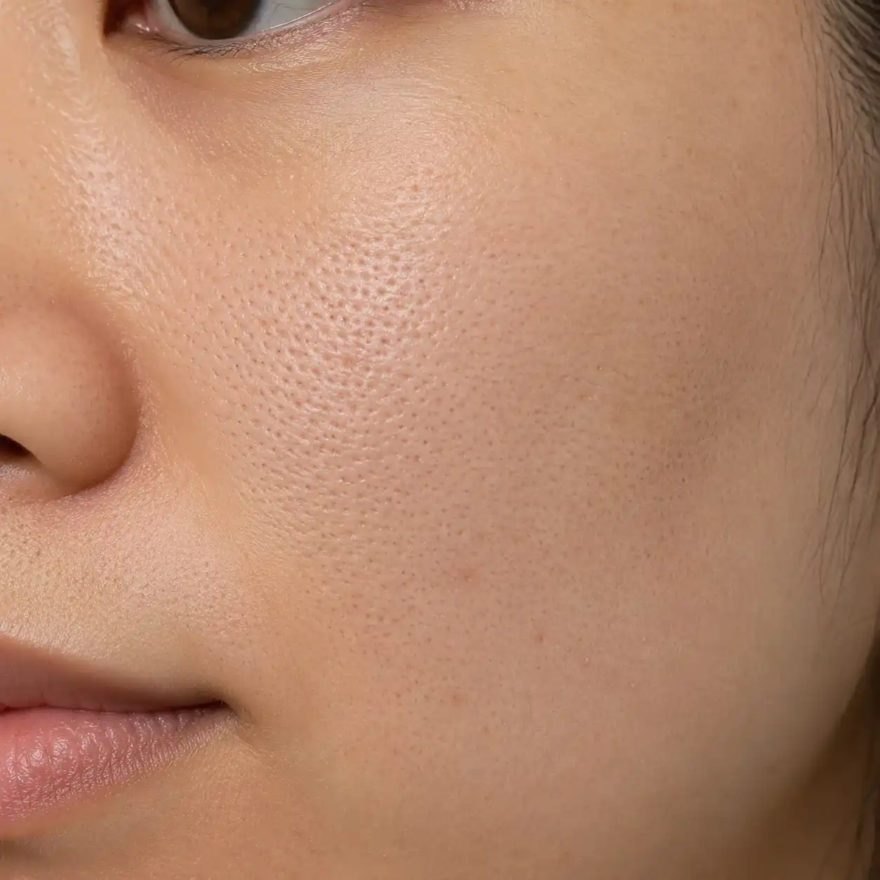 enlarged pores